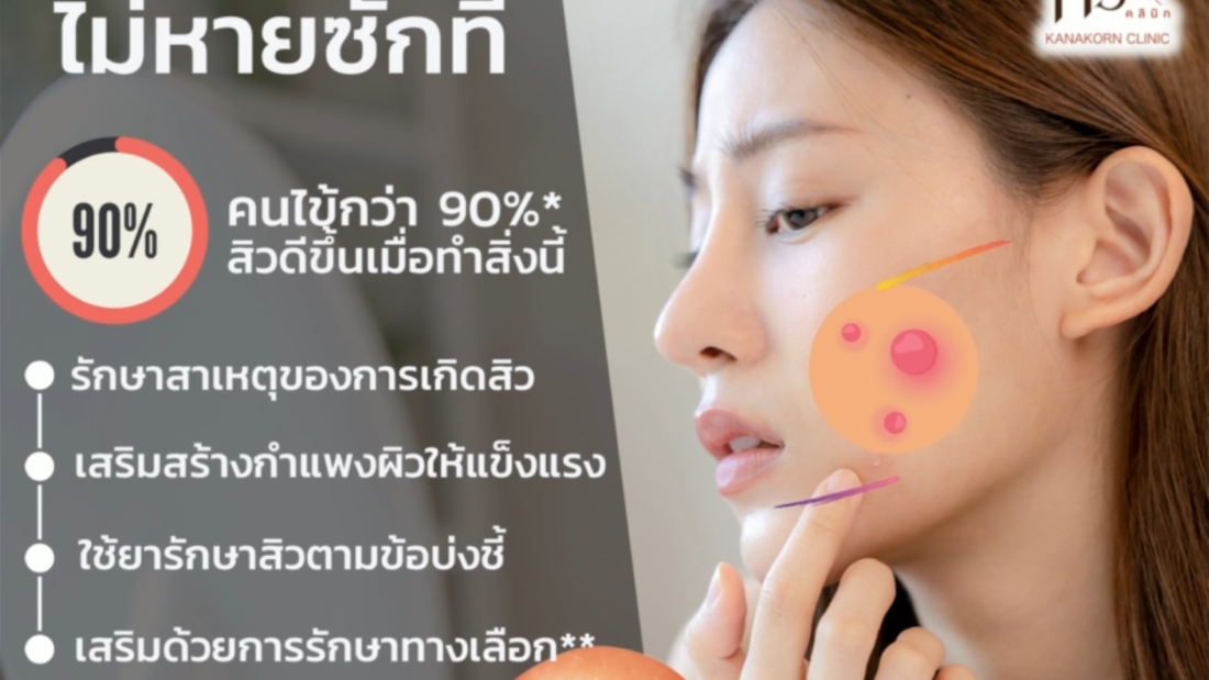 acne problem improved when doing this